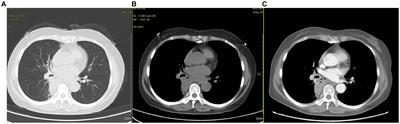 Bronchopulmonary foregut malformation with severe hemoptysis in advanced age: a case report and literature review